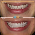 composite veneers