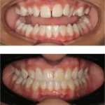 thumbnail porcelain veneers before and after 746x800